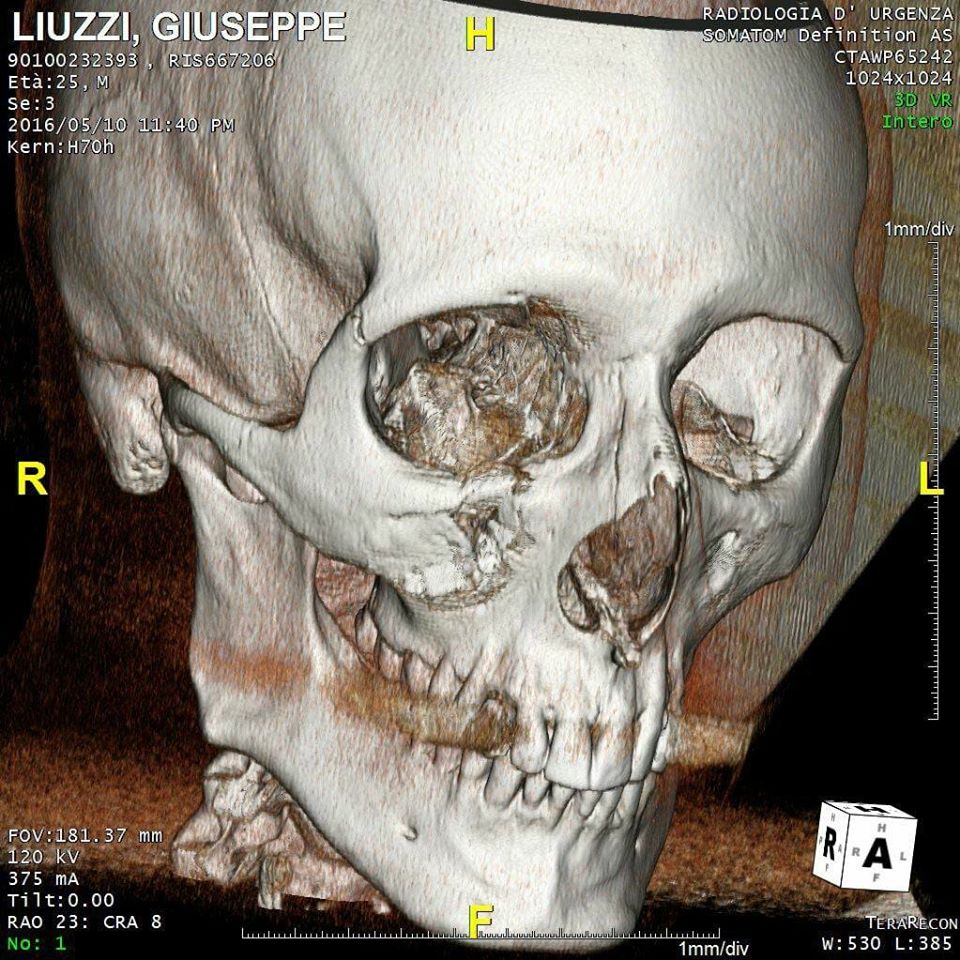 Giuseppe Liuzzi - Frattura - Stampa 3D